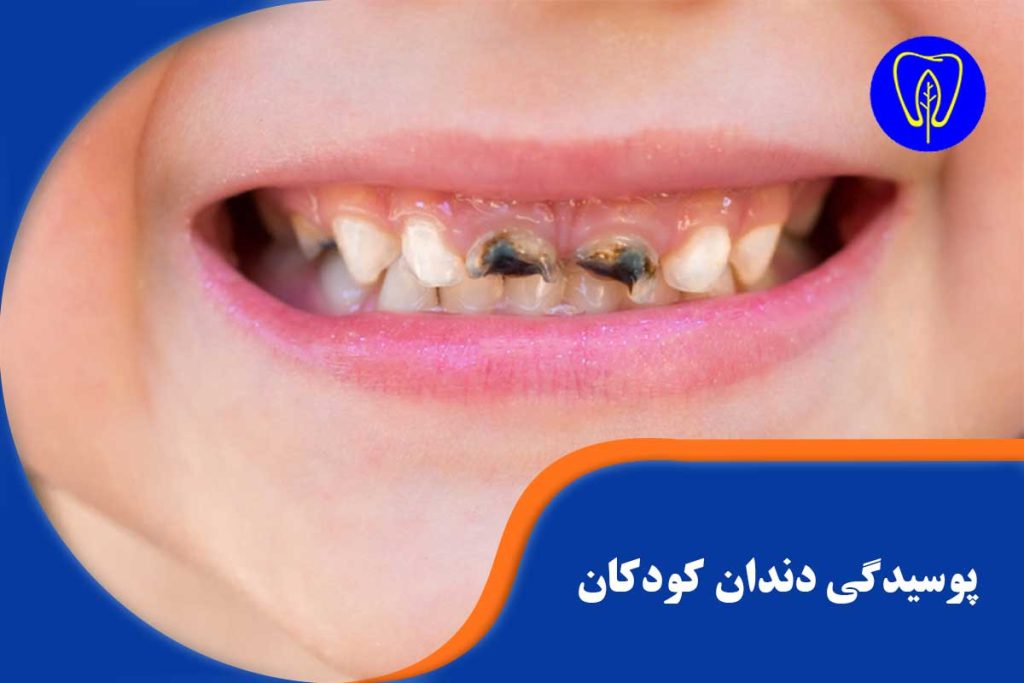 پوسیدگی دندان کودکان