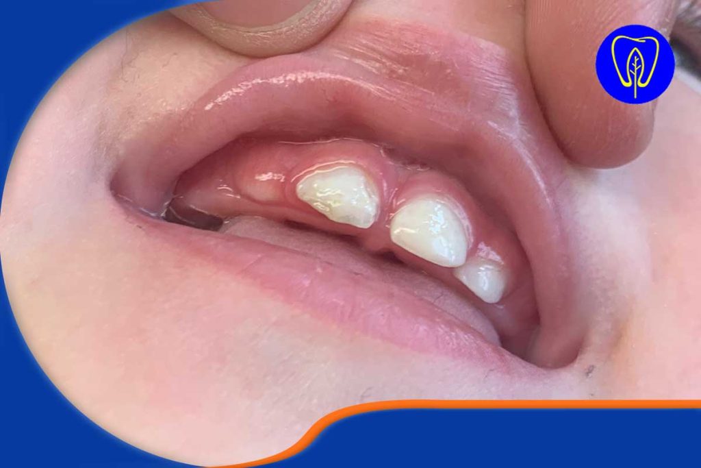 هیپوپلازی مینای دندان کودک