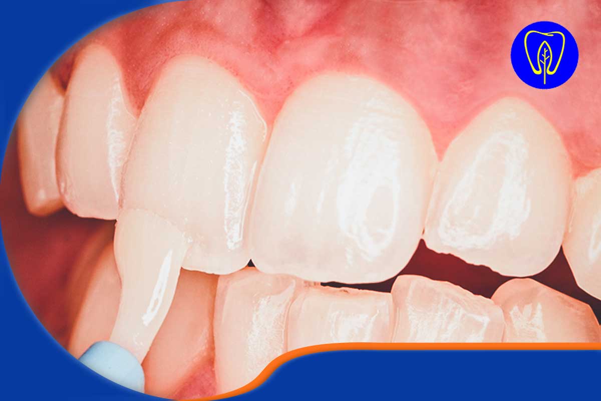 دستورالعمل‌های پس از وارنیش فلوراید 