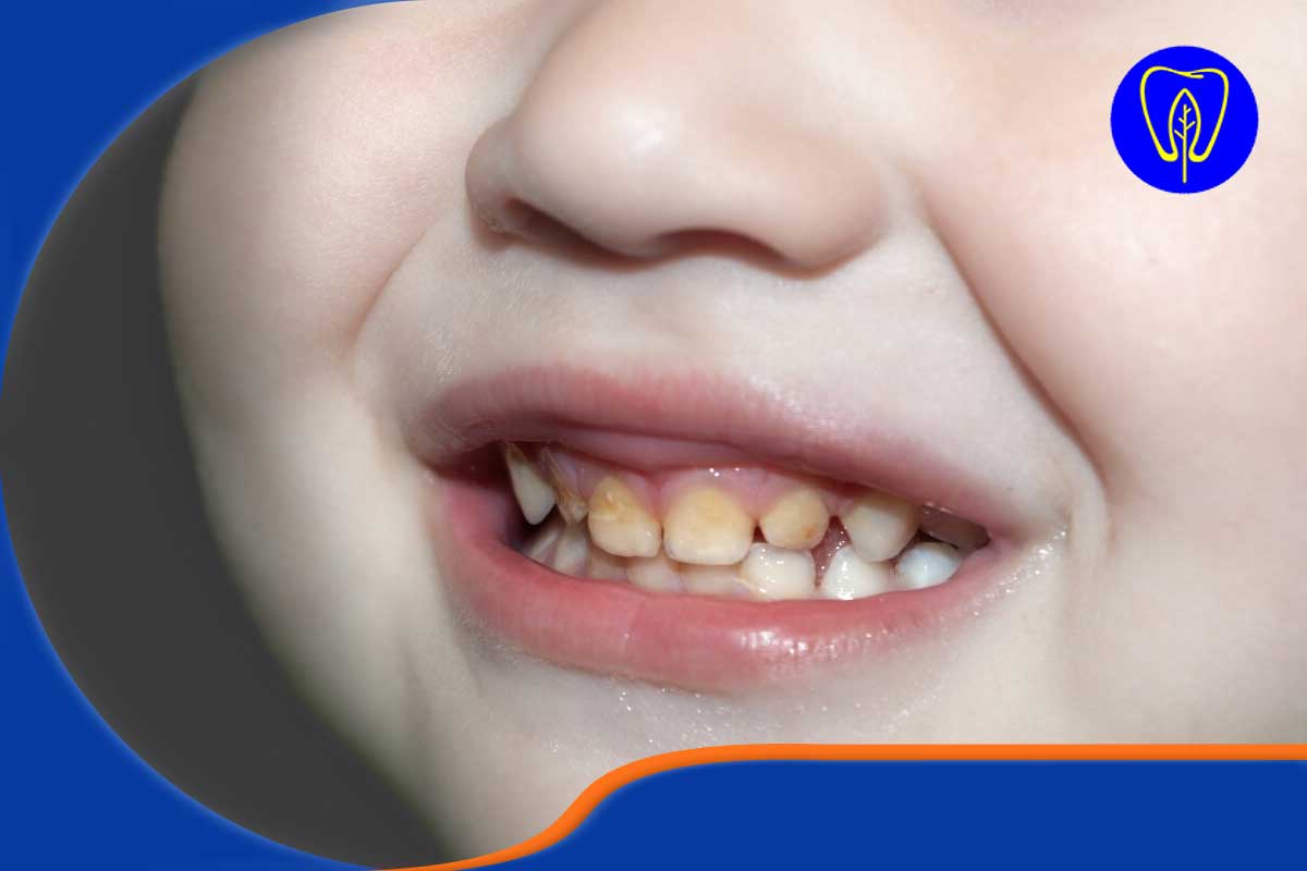 پیشگیری از تغییر رنگ دندان‌ کودکان 