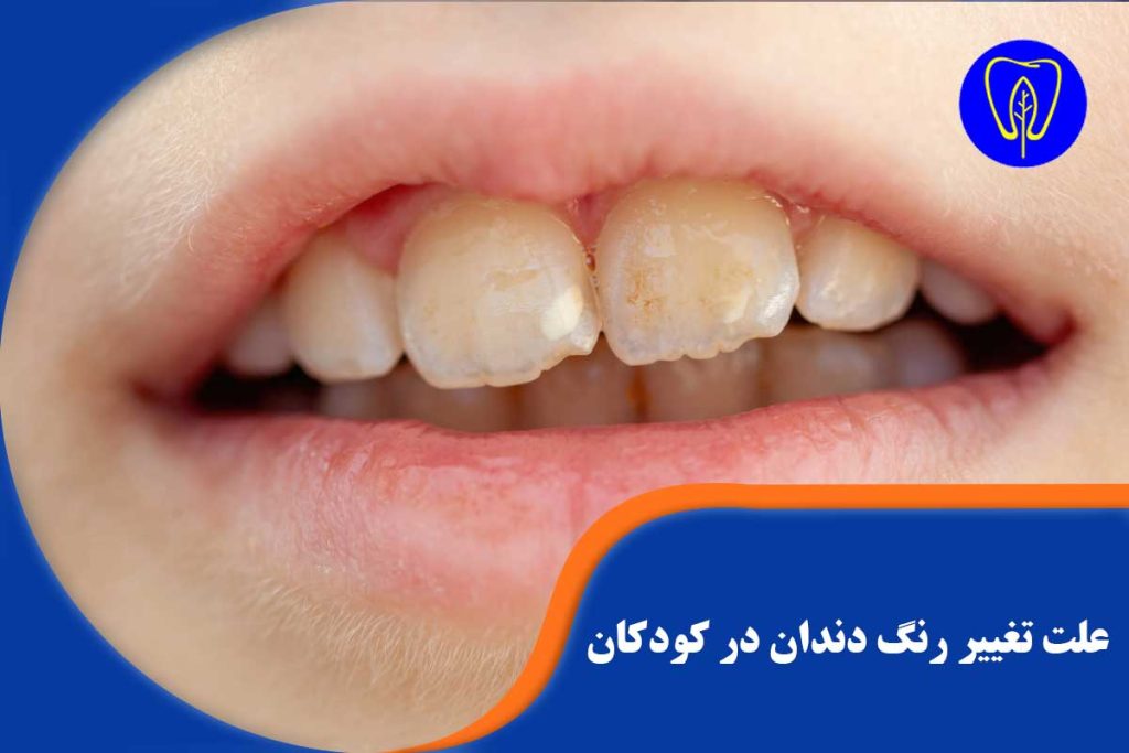 تغییر رنگ دندان در کودکان