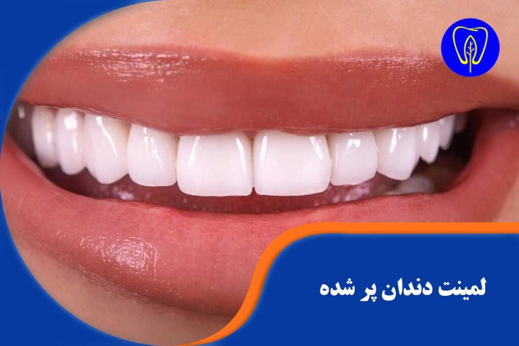 لمینت دندان پر شده
