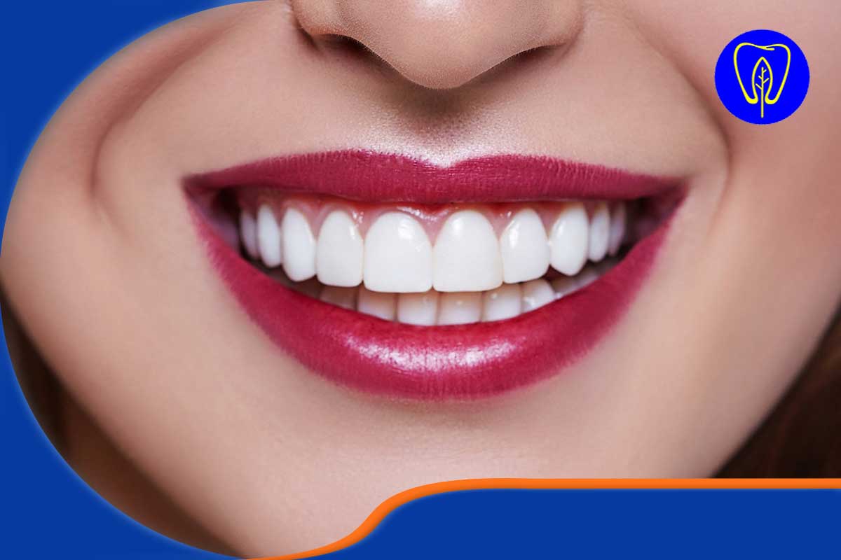 پیش نیاز اصلی برای انجام لمینت روی دندان‌های ترمیم شده