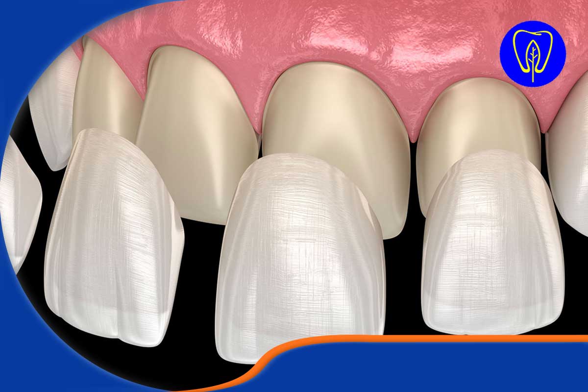 مراحل لمینت دندان پر شده