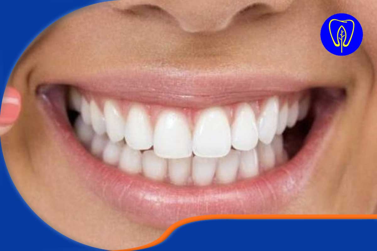 لمینت دندان ترمیم شده