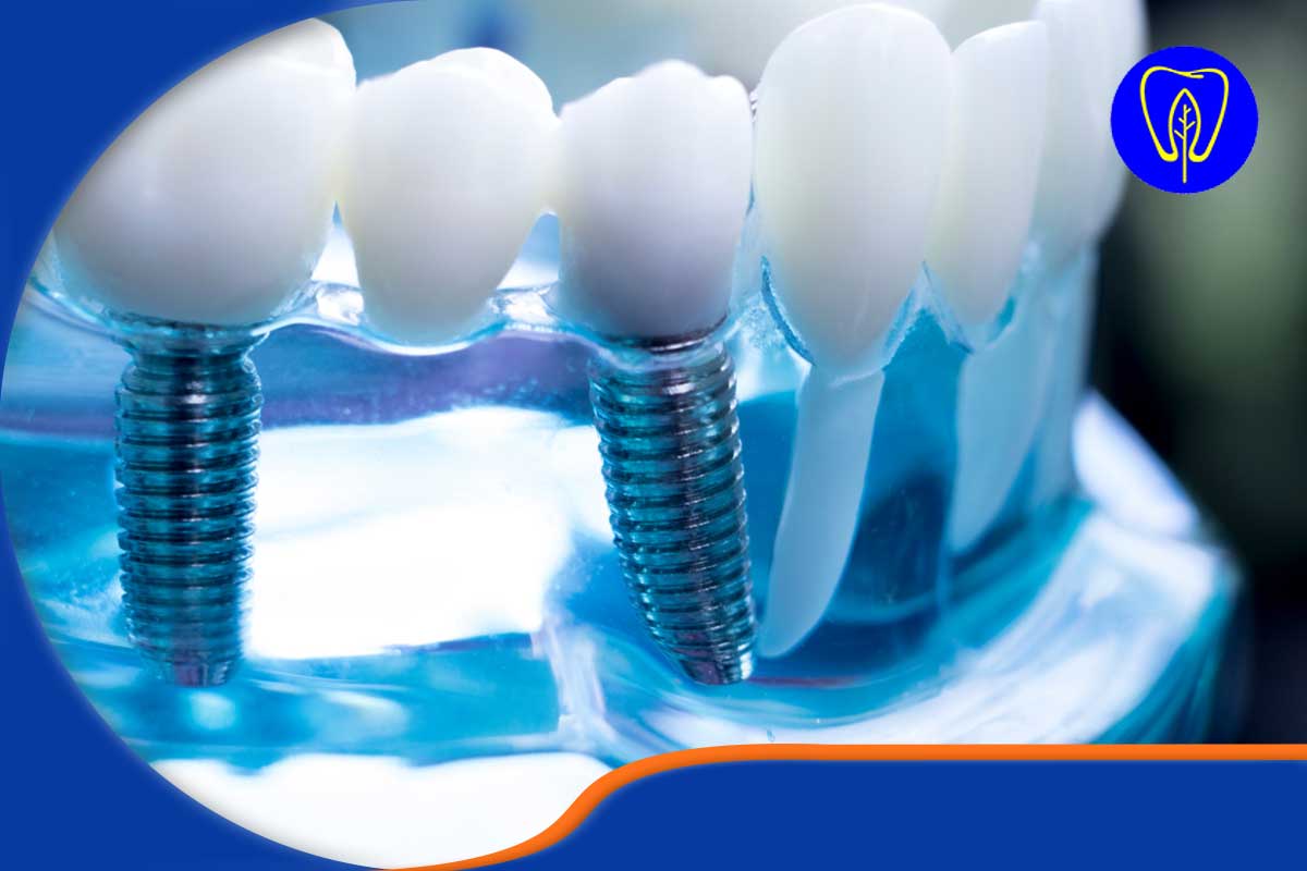 ایمپلنت دندان چیست و چگونه عمل می‌کند؟