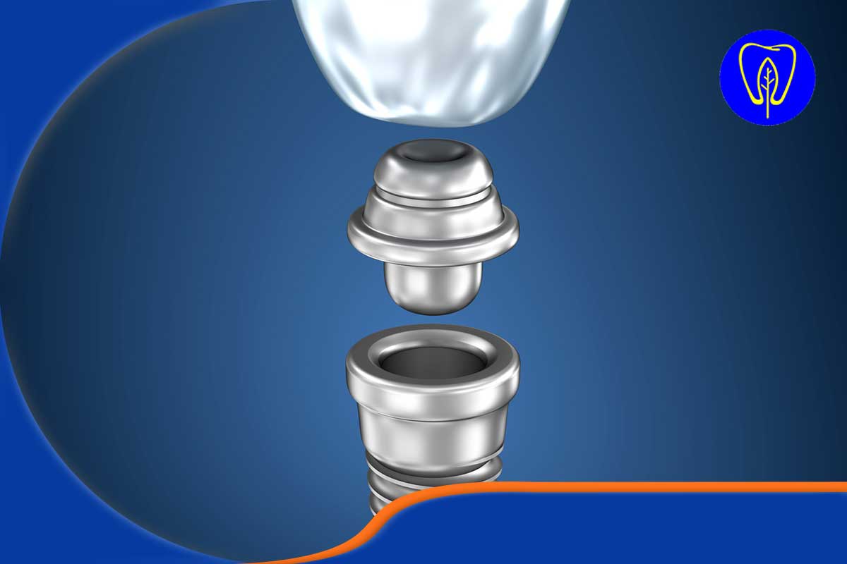 پروتز دندان بهتره یا ایمپلنت؟