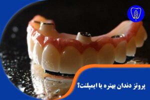 پروتز دندان بهتره یا ایمپلنت