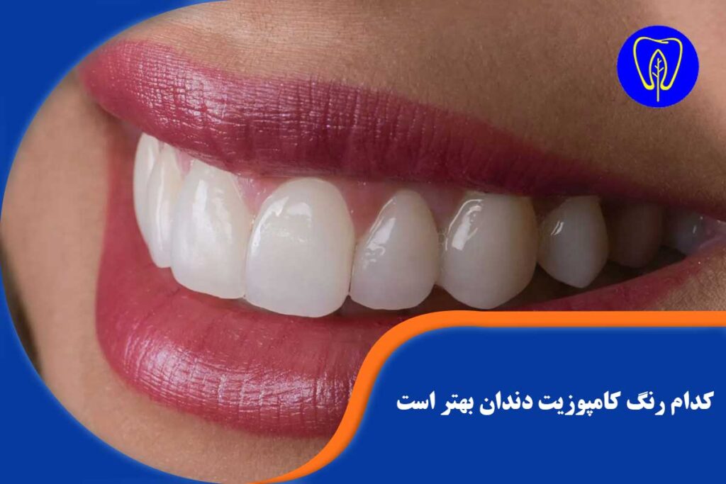 بهترین رنگ کامپوزیت دندان