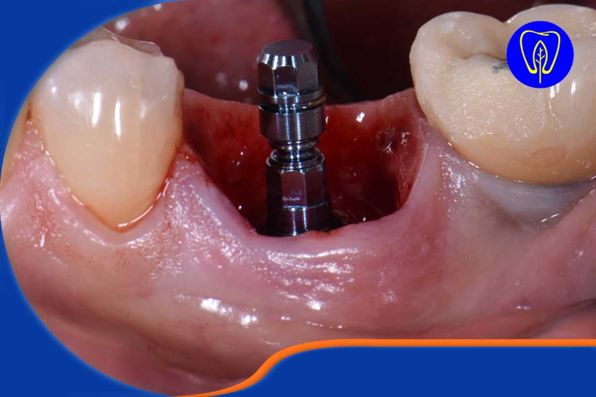 هنر کشیدن دندان بدون آسیب (Atraumatic Extraction): خشت اول ایمپلنت