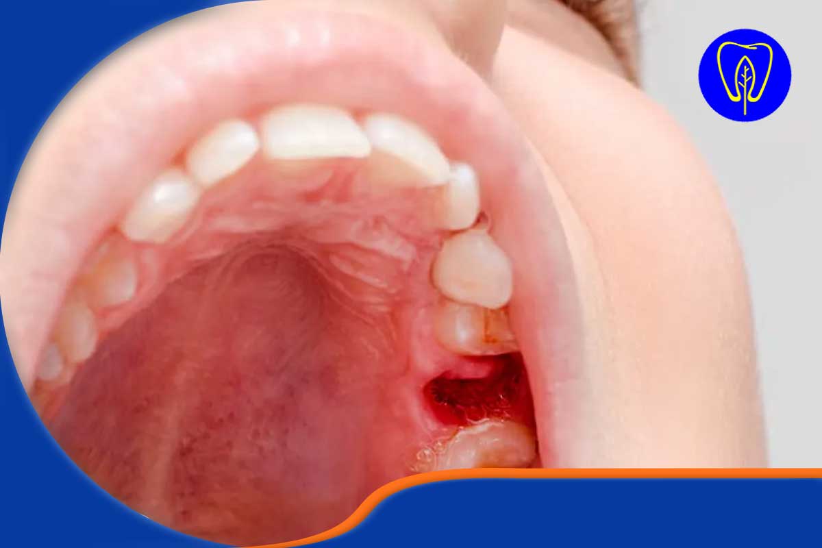 آیا بیمه‌های درمانی هزینه کشیدن دندان عقل را پوشش می‌دهند؟