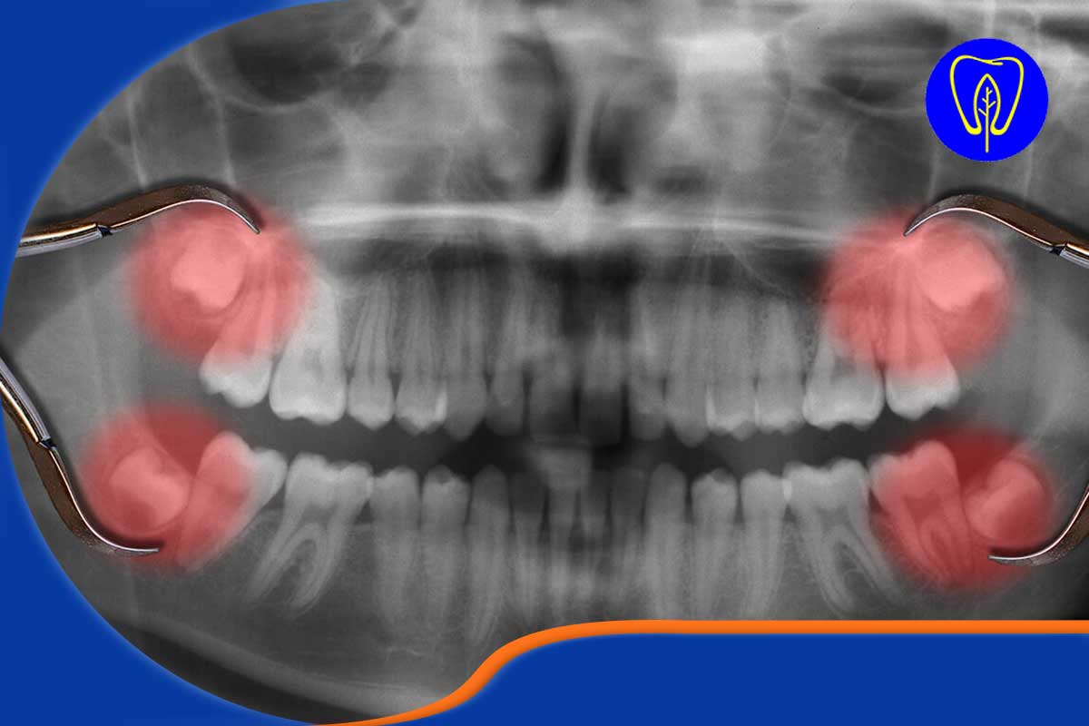چرا قیمت کشیدن دندان عقل ثابت نیست؟ (شناخت انواع دندان عقل)