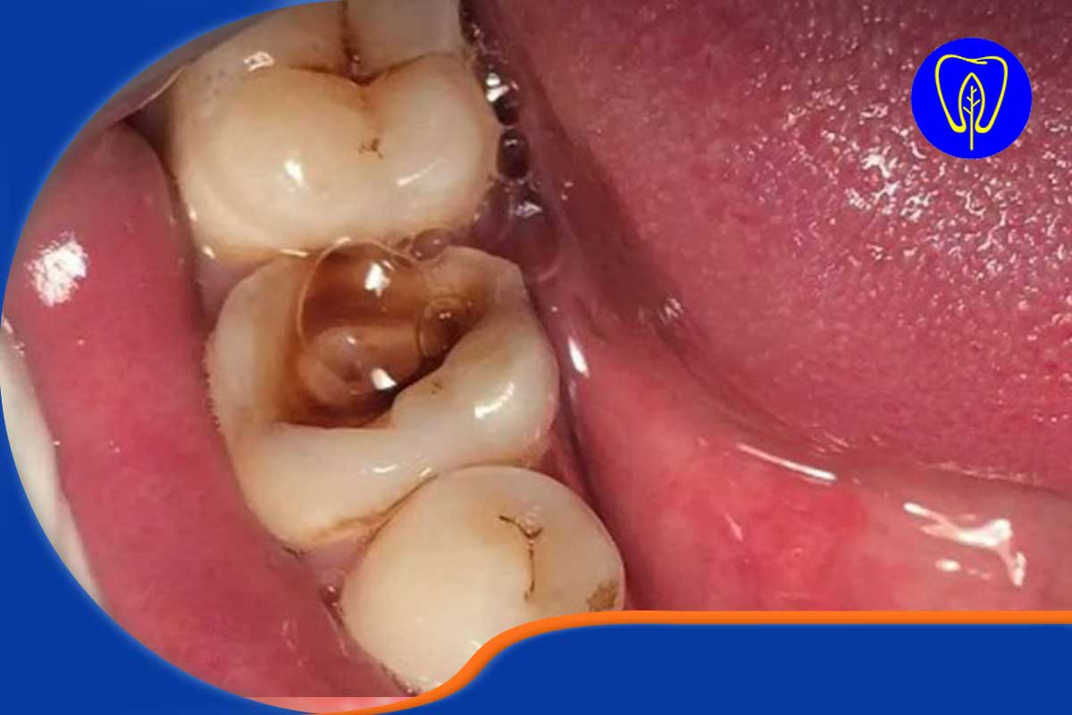 آناتومی یک فاجعه: چگونه یک پوسیدگی ساده به عصب دندان می‌رسد؟