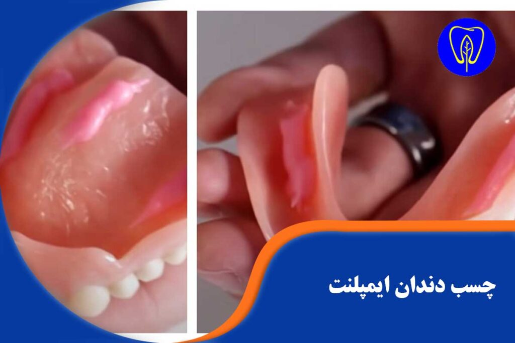 چسب دندان ایمپلنت
