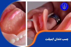 چسب دندان ایمپلنت