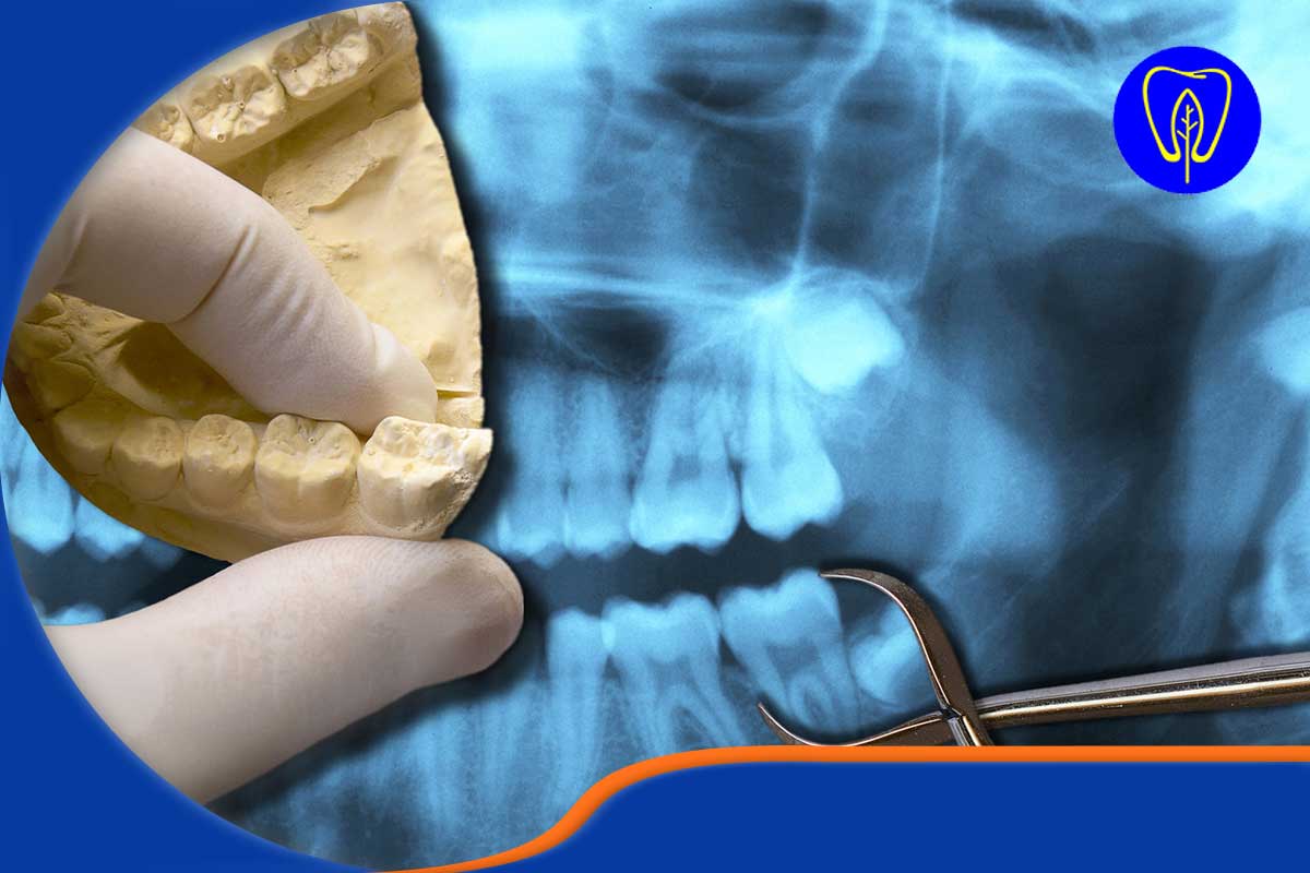 دوراهی سرنوشت‌ساز: عصب‌کشی یا کشیدن دندان؟ (جدول مقایسه)