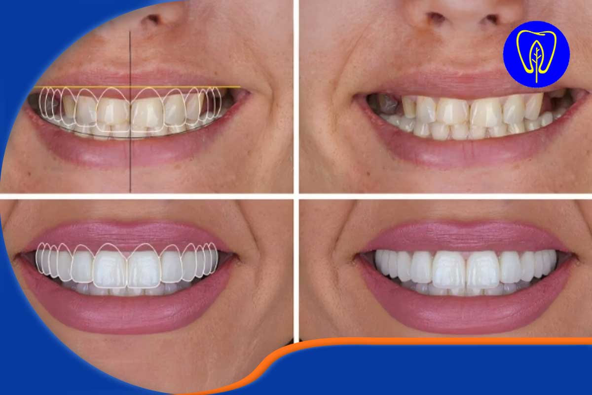 جدول راهنمای جامع مقایسه خدمات پرطرفدار دندانپزشکی زیبایی