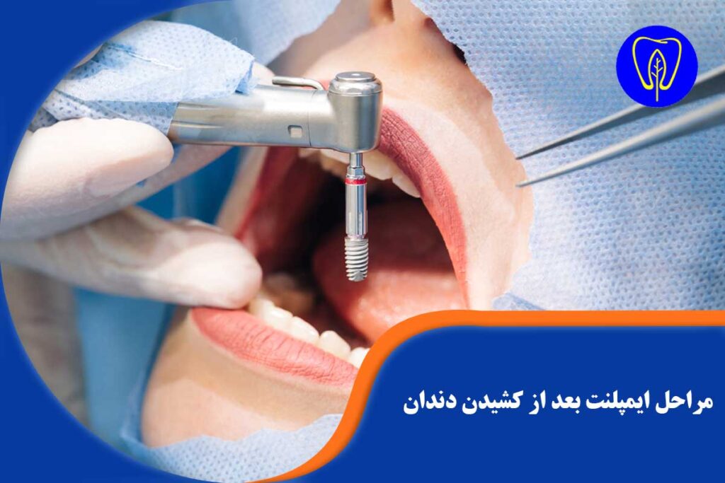 ایمپلنت بعد از کشیدن دندان