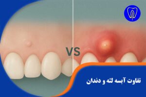 آبسه لثه یا دندان؟