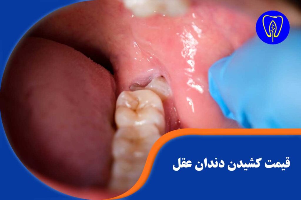 قیمت کشیدن دندان عقل