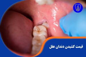 قیمت کشیدن دندان عقل