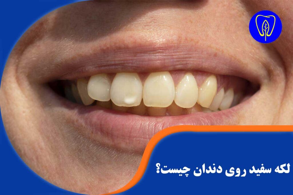 لکه سفید روی دندان