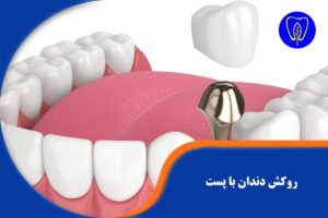 روکش دندان با پست