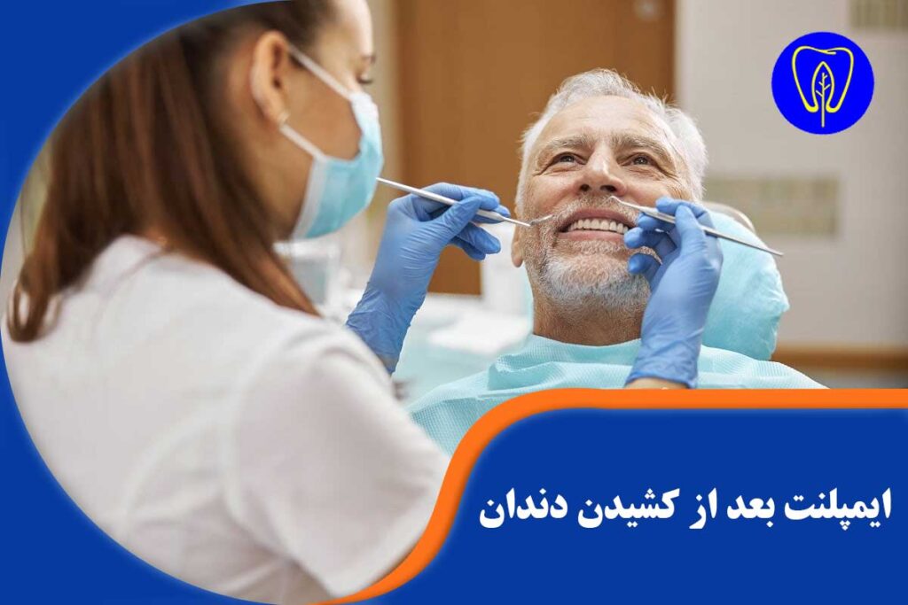 ایمپلنت بعد از کشیدن دندان